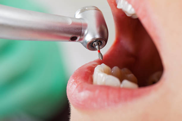 Best Emergency Dental Care for Abscessed Tooth in Marist College, NY